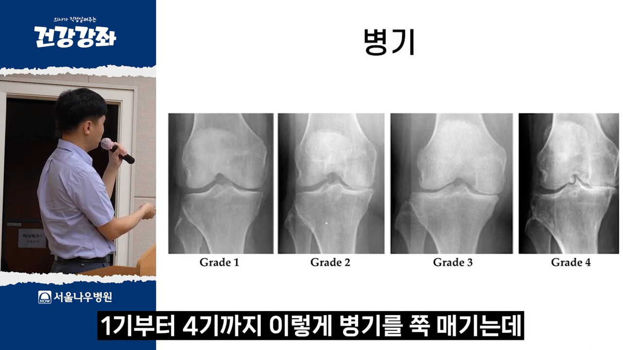 퇴행성 관절염 최신 정보와 확인 포인트: 빠르게 판단하기