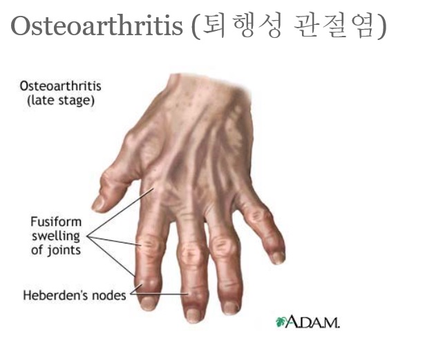 [진료일기] 운정 손가락 퇴행성 관절염 관련 이미지