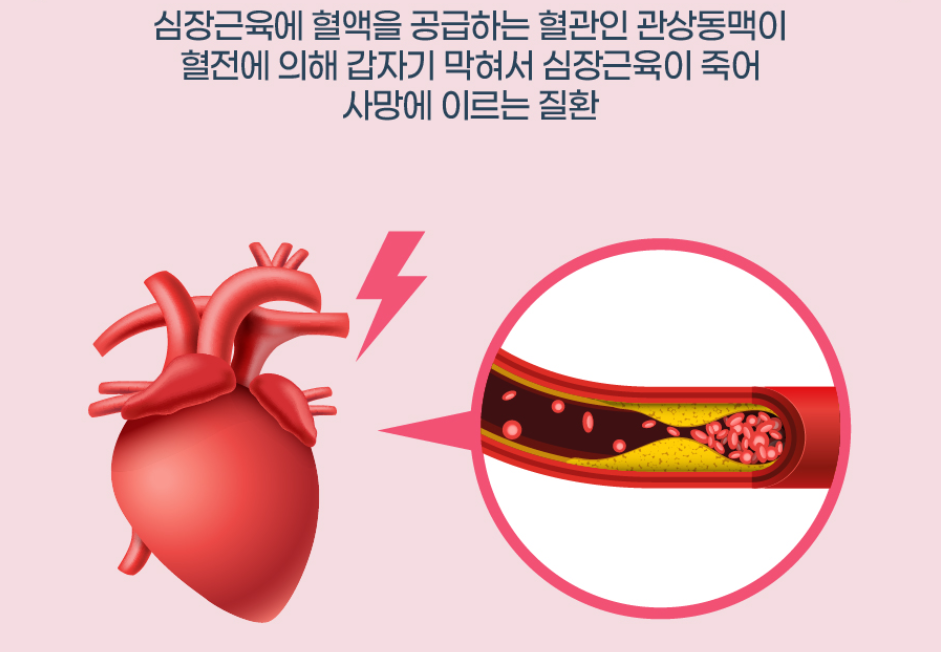 심근경색 증상: 즉시 확인해야 할 체크포인트와 상담 기준