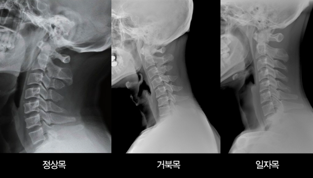일자목 통증, 스마트폰 사용 줄이기 전 체크할 핵심 포인트와 상담 기준