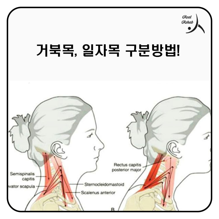 [거북목, 일자목 구분 방법] 목 통증 탈출하고 싶다면 이것 보세요!! 관련 이미지